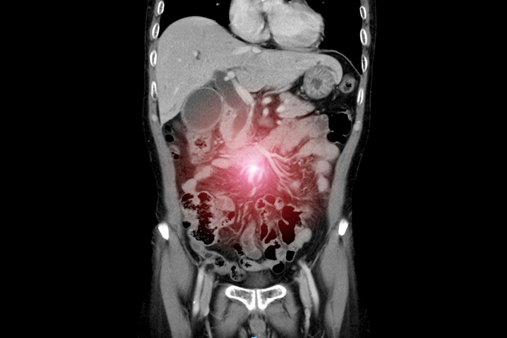 Peritoneal cancer surgery